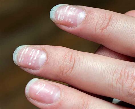 define leukonychia|Leukonychia and Other Nail Discoloration: An Overview.